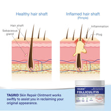 Load image into Gallery viewer, TAGRID Folliculitis