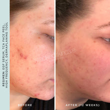 Load image into Gallery viewer, StackedSkincare High Frequency Facial Wand - Portable Skin Therapy Tool with Neon &amp; Argon Electrodes - Helps Support Clearer Looking Skin &amp; Scalp for Face, Hair, and Temporary Acne Appearance Care